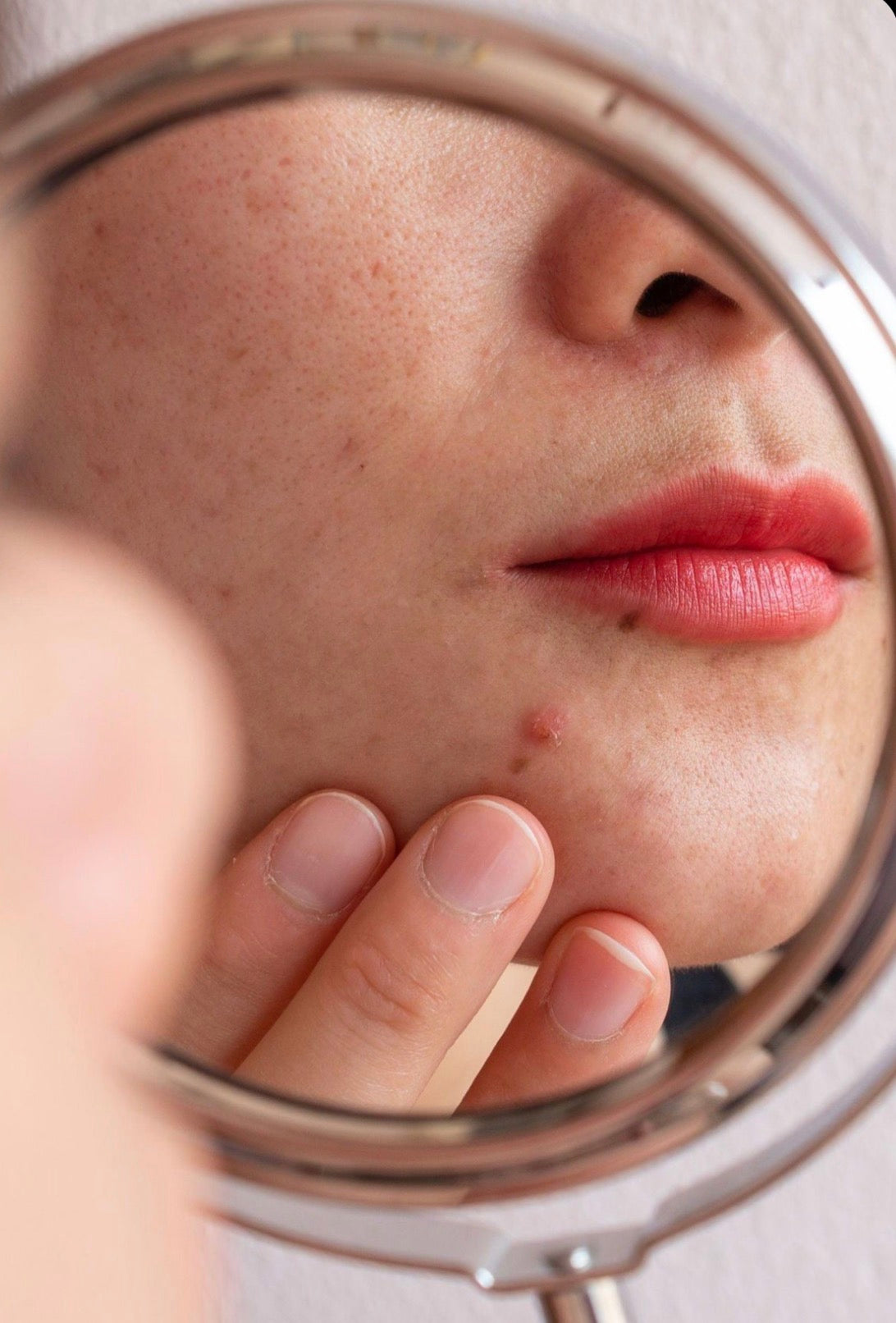 What To Do When Your Skin Suddenly Starts Breaking Out