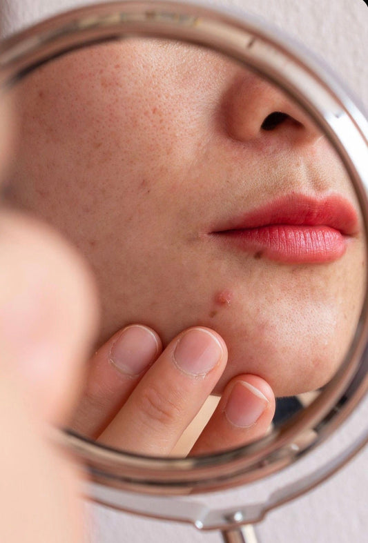 What To Do When Your Skin Suddenly Starts Breaking Out