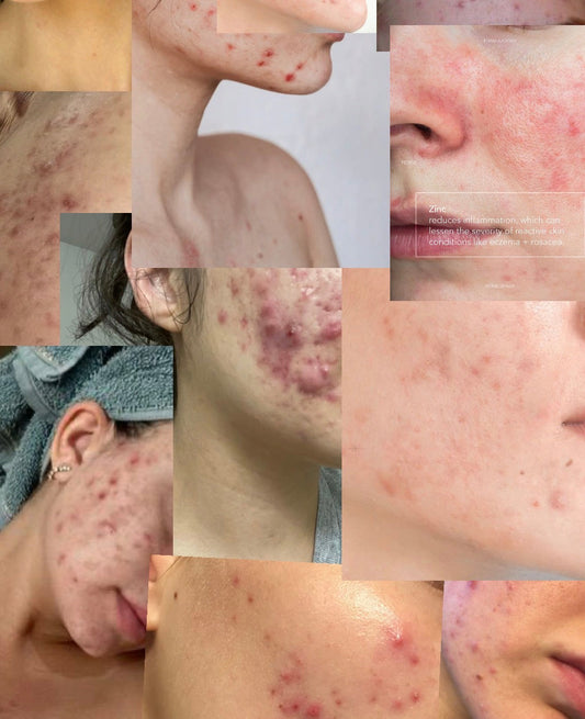 Why Over-Treating Acne Often Makes It Worse