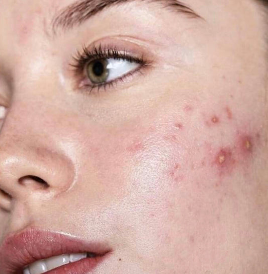 Understanding the Different Types of Acne